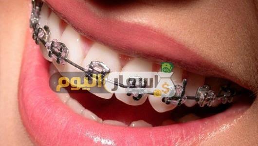 Photo of ثمن تقويم الأسنان بالمغرب