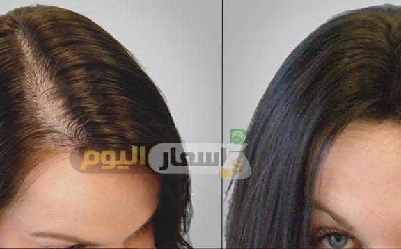 Photo of تكلفة زراعة الشعر في مصر 2024