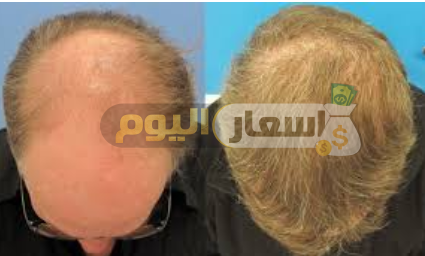 سعر زراعة الشعر في مصر 2019