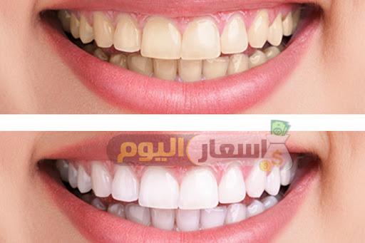 أسعار تبييض الأسنان بالليزر في مصر